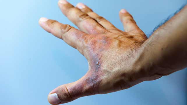 burn on hand