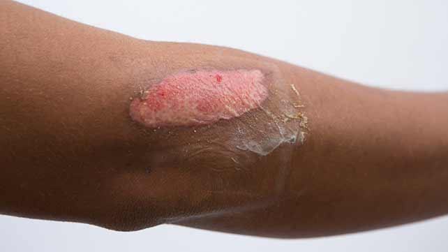 burn on arm