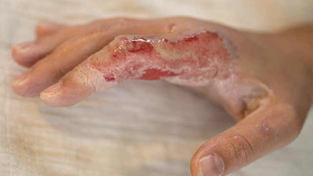 burn on hand