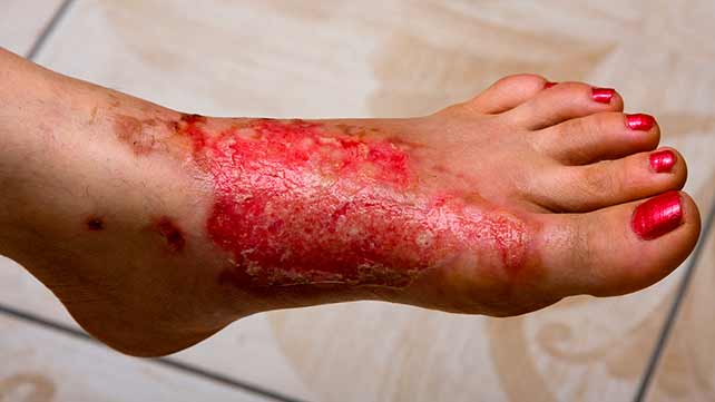 burn on foot