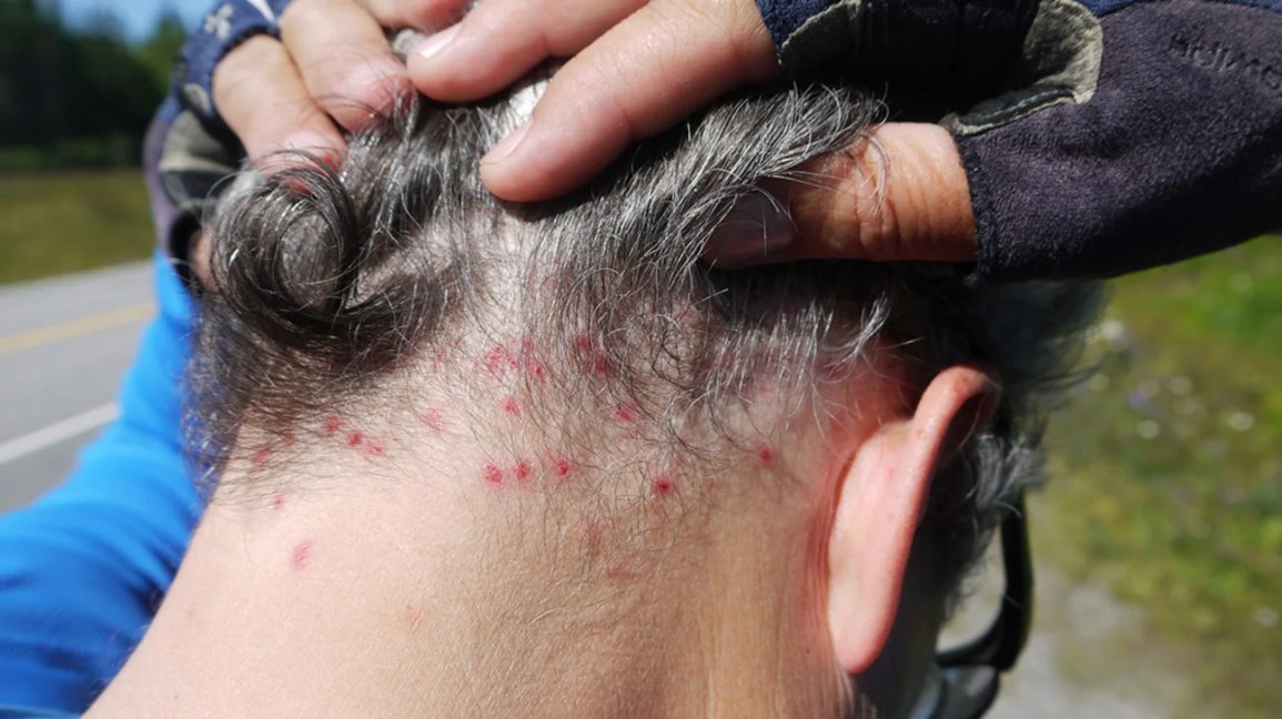 fly bites on the back of the neck