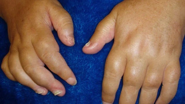 Swollen fingers from arthritis.