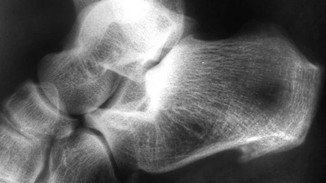 Plantar fasciitis on an x-ray