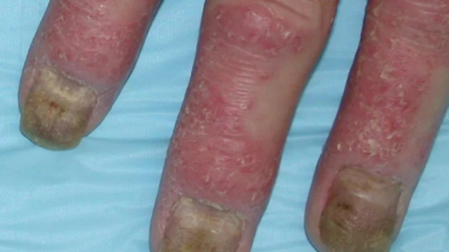 Fingers with peeling skin from psoriatic arthritis