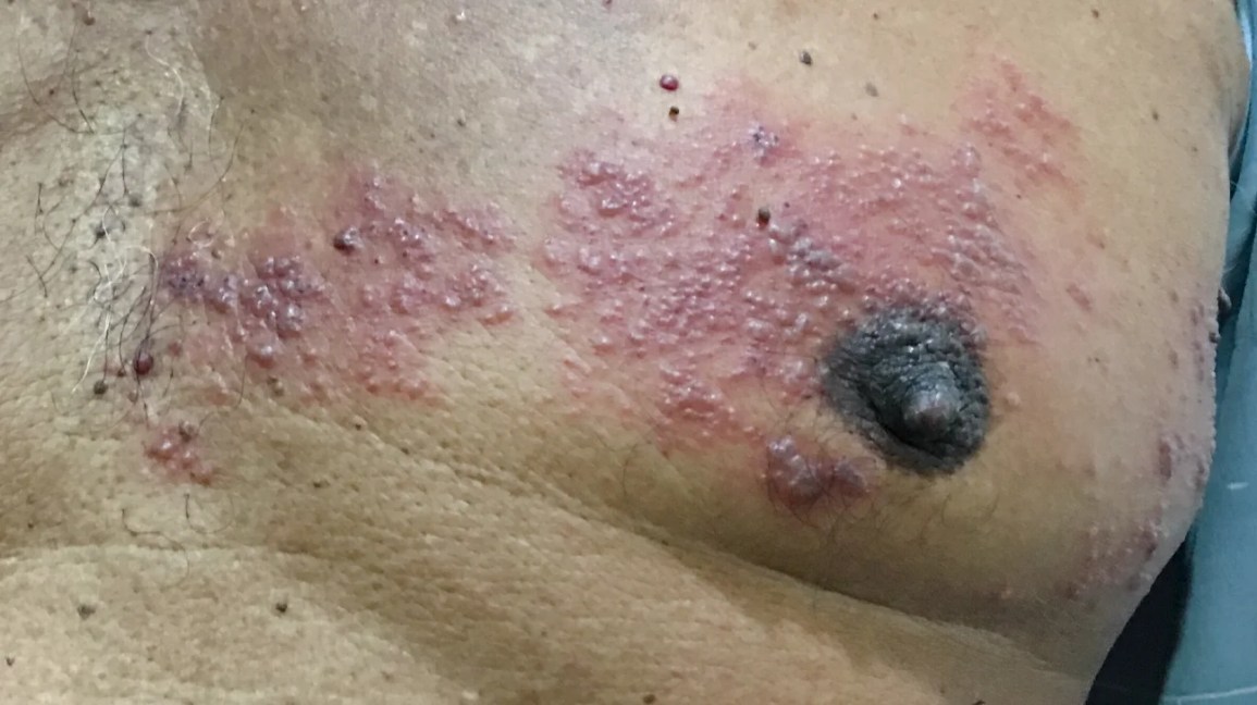 Picture of shingles rash on the chest
