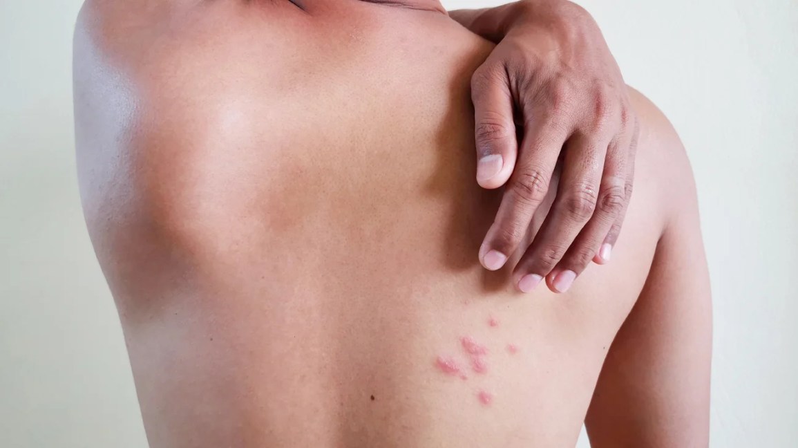 Picture of shingles rash on the back