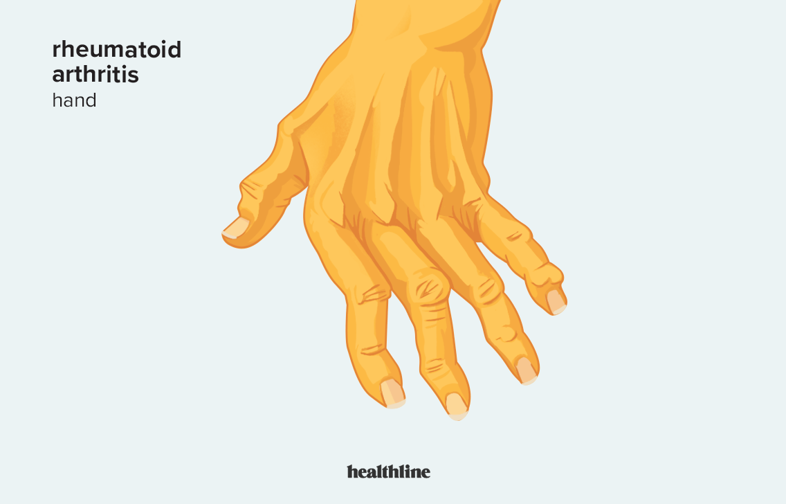 Illustration of RA in the hand.
